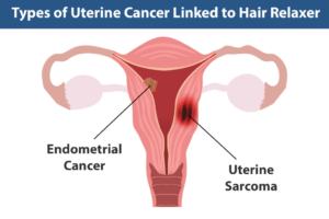 Endometrial cancer misdiagnosis