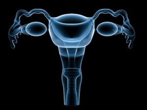 Endometrial cancer misdiagnosis Long island New York