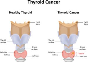 Cancer Thyroid Lawyer Long Island