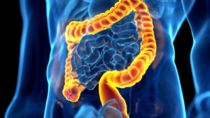 Colon Cancer Misdiagnosis Lawyer Westchester