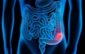 Colon Cancer Misdiagnosis Lawyer
