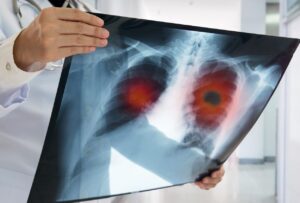 Lung Cancer Attorney New York - Lung Cancer Long Island New York