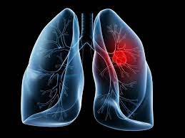 Lung Cancer Misdiagnosis