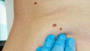 Skin Cancer Lawyers Westchester Misdiagnosis