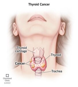 Thyroid Cancer Attorney New York
