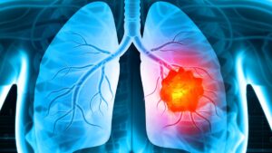 Lung Cancer Misdiagnosis Attorney New York